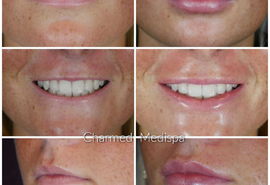 Lip filler helps to show more lip when smiling.