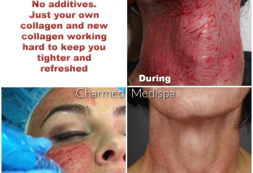 Microneedling of the face and neck to improve wrinkles, textures and boost collagen in our Newark, Delaware med spa