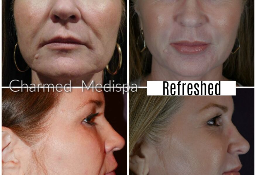 botox and fillers med spa