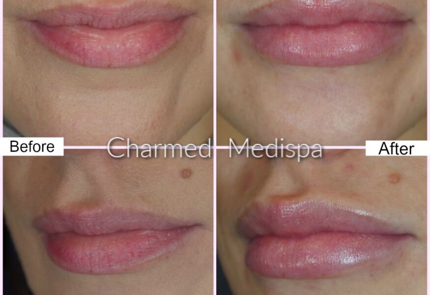 Med Spa lip filler before and after