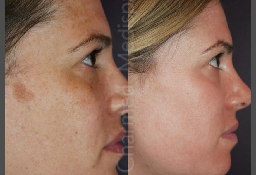 Before and after photos after using ZO Skin Health