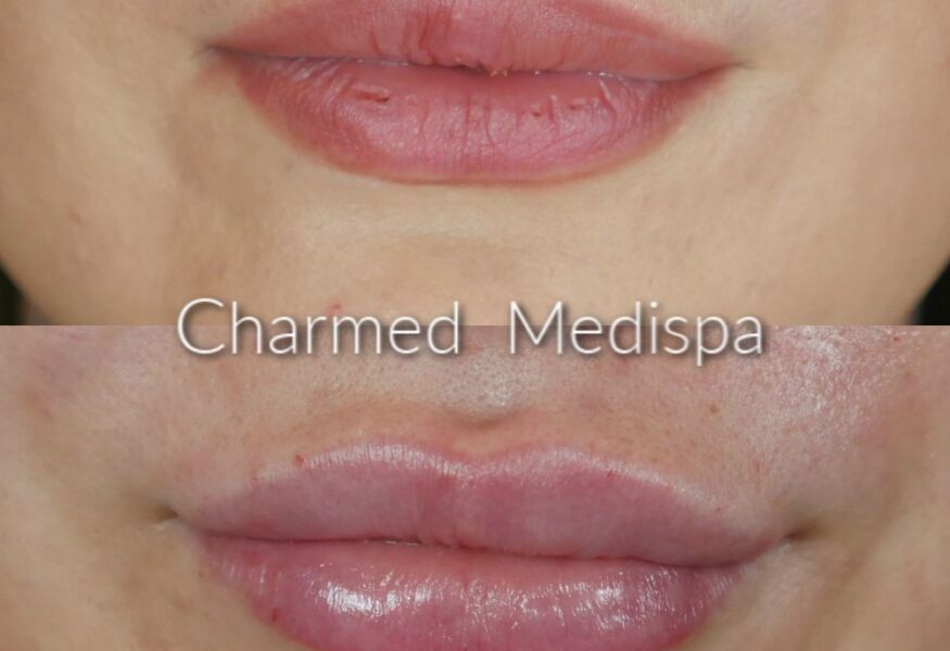 Before and after photos of lip filler