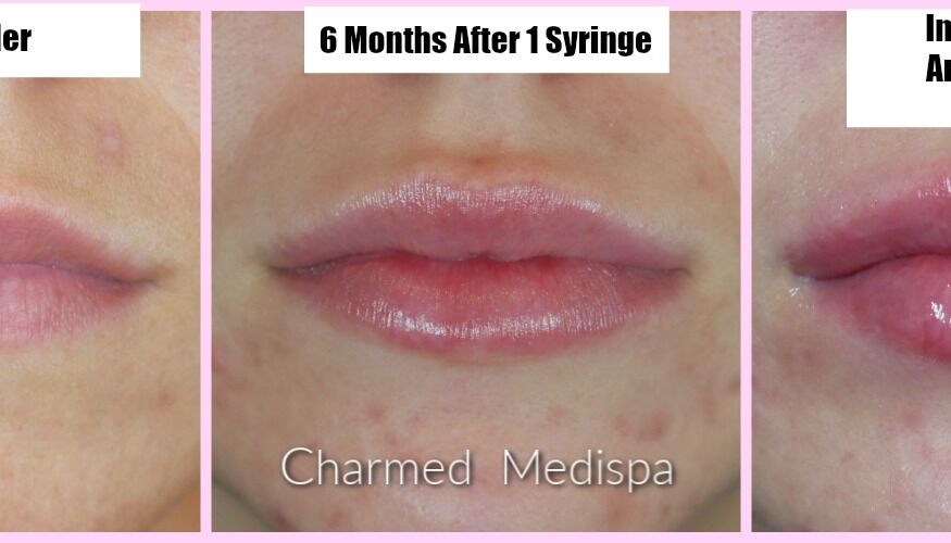 Lip filler performed by our injection expert at our Delaware med spa, Charmed Medispa.