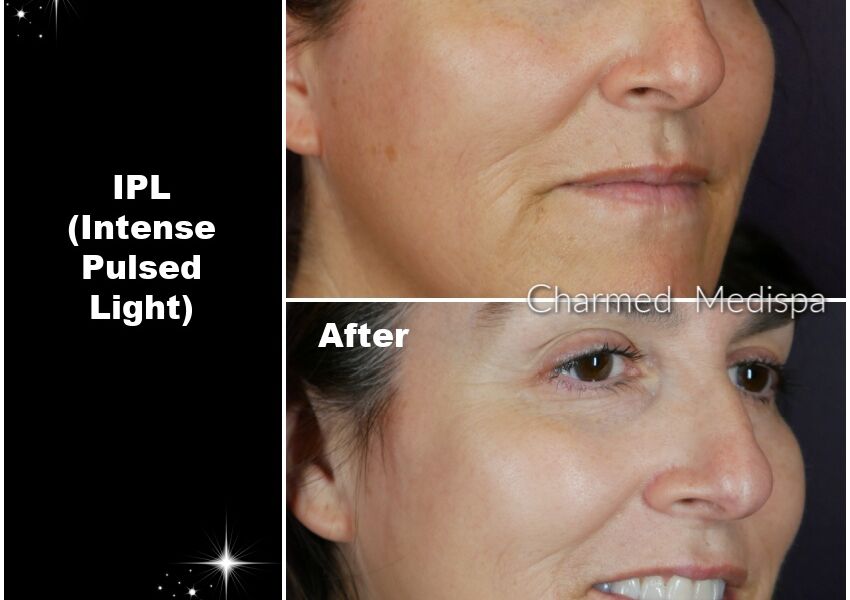 IPL to improve pigmenation, redness and overall skin tones. This before and after photo is with just one treatment.